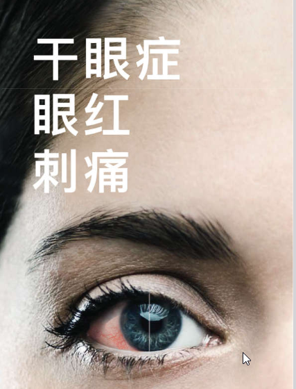 Itchy Irritated Dry Eyes